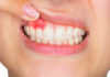 5 Most Common Causes of Gum Bleeding